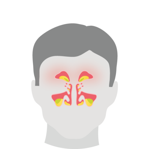 Nasodren® - Natural Treatment for Sinus Infection Symptoms